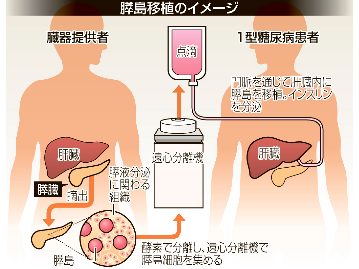 膵島移植のイメージ